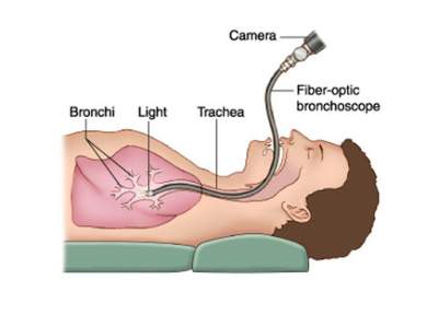 Fiberoptic and Rigid Bronchoscopy in Bilaspur